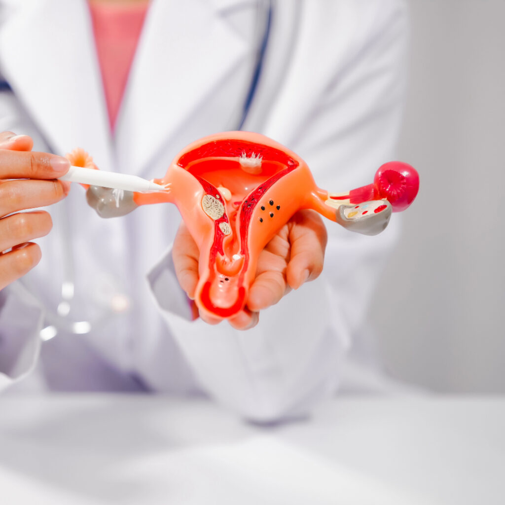 Polycystic Ovary Syndrome (PCOS) and Weight Loss